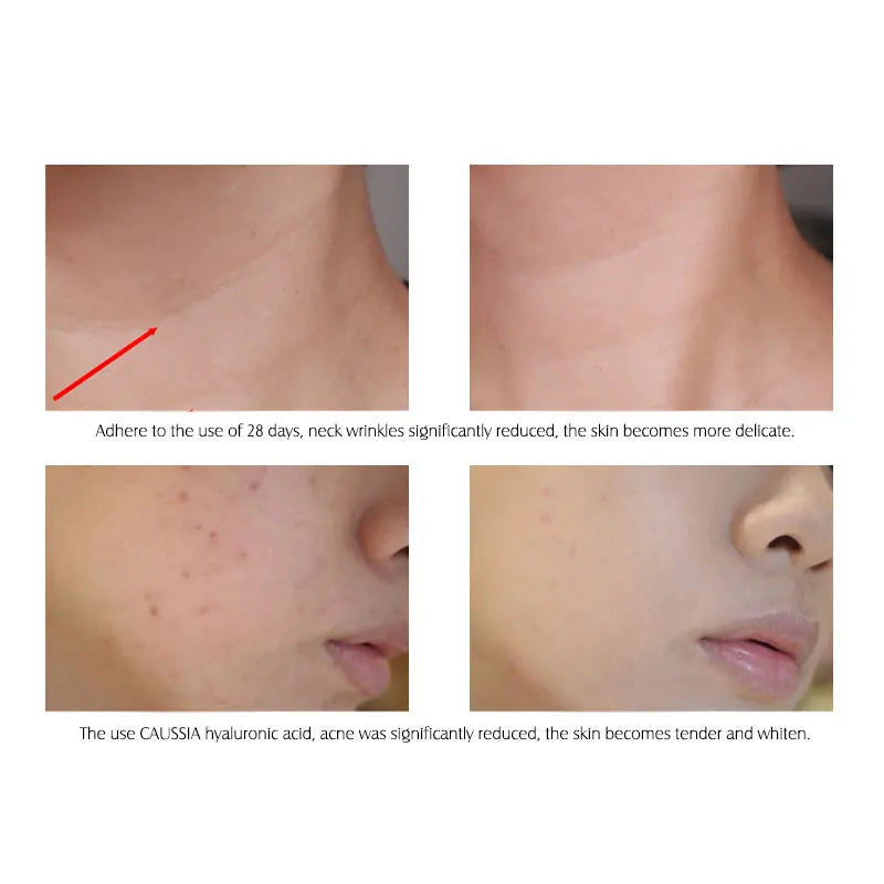 ARTISCARE Hyaluronic Acid Serum 2PCS Moisturizing and Wrinkles HA Essence for Face Skin Care Firming Facial Cream