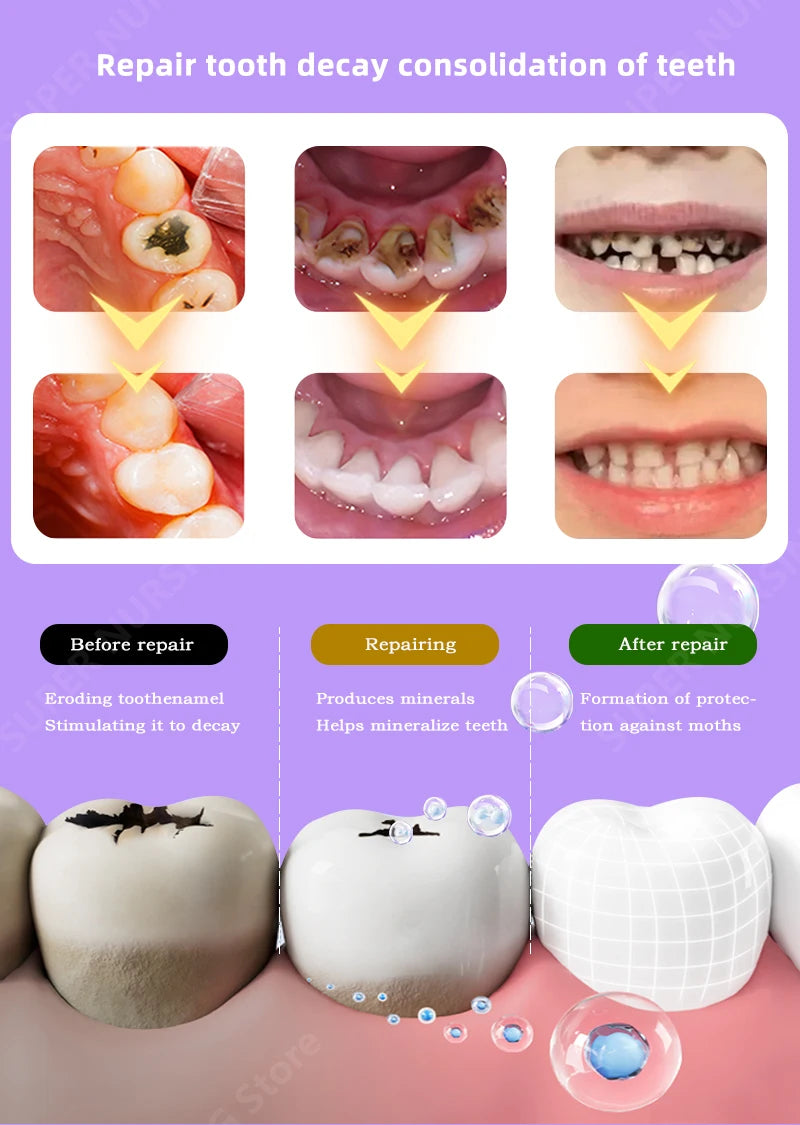 Anti Caries Tooth Decay Healing Cavities